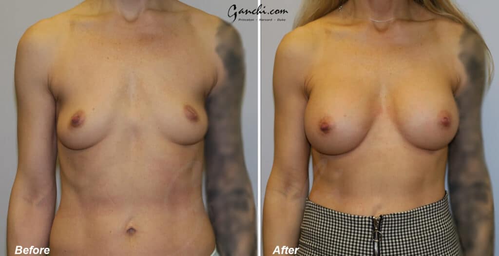 Breast Augmentation Before and After Photo by Ganchi Plastic Surgery in Northern New Jersey