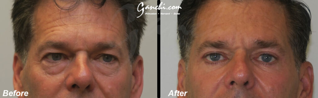 Eyelid Lift Before and After Photo by Ganchi Plastic Surgery in Northern New Jersey