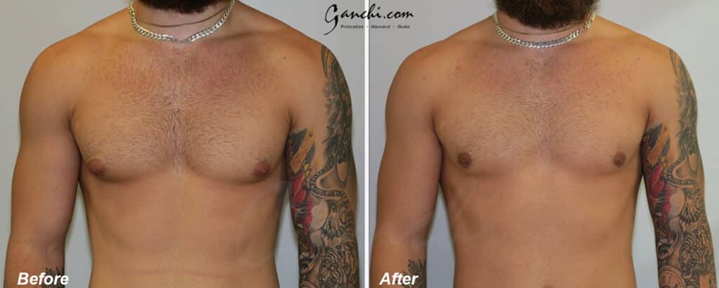 Gynecomastia Before and After Photo by Ganchi Plastic Surgery in Northern New Jersey