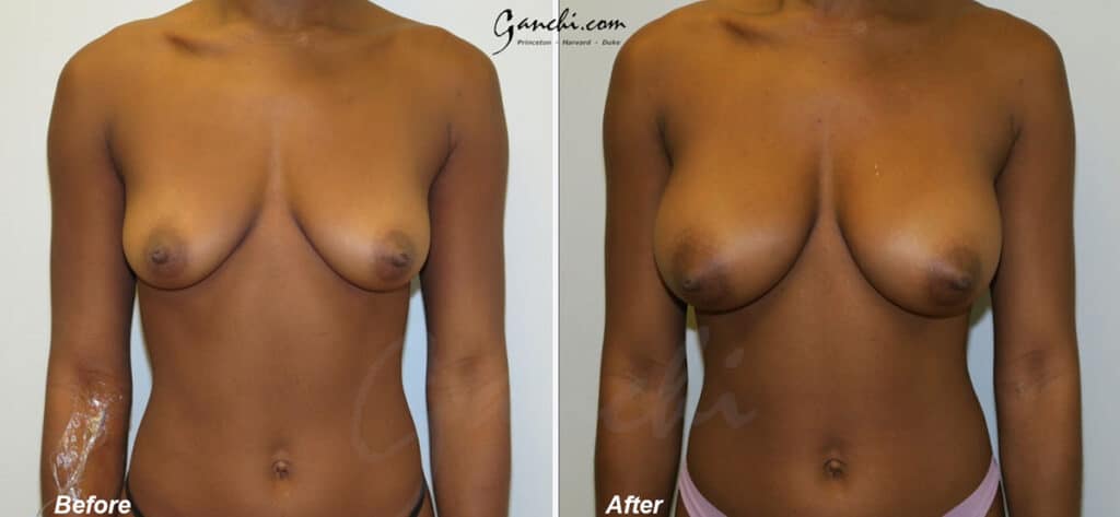 Breast Augmentation Before and After Photo by Ganchi Plastic Surgery in Northern New Jersey
