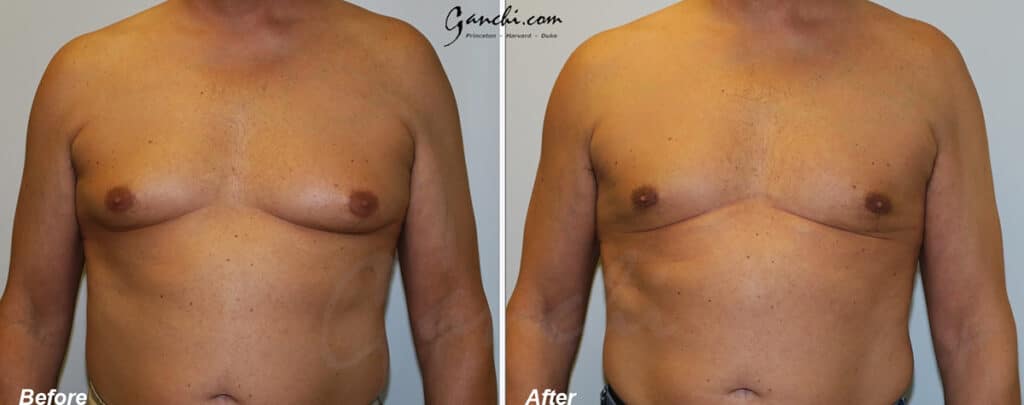 Gynecomastia Before and After Photo by Ganchi Plastic Surgery in Northern New Jersey