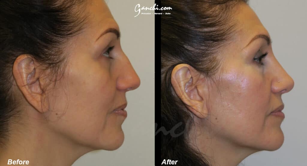 Rhinoplasty Before and After Photo by Ganchi Plastic Surgery in Northern New Jersey