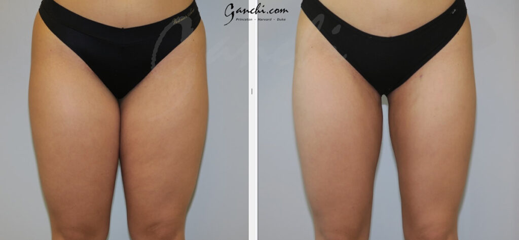 Liposuction Before and After Photo by Ganchi Plastic Surgery in Northern New Jersey