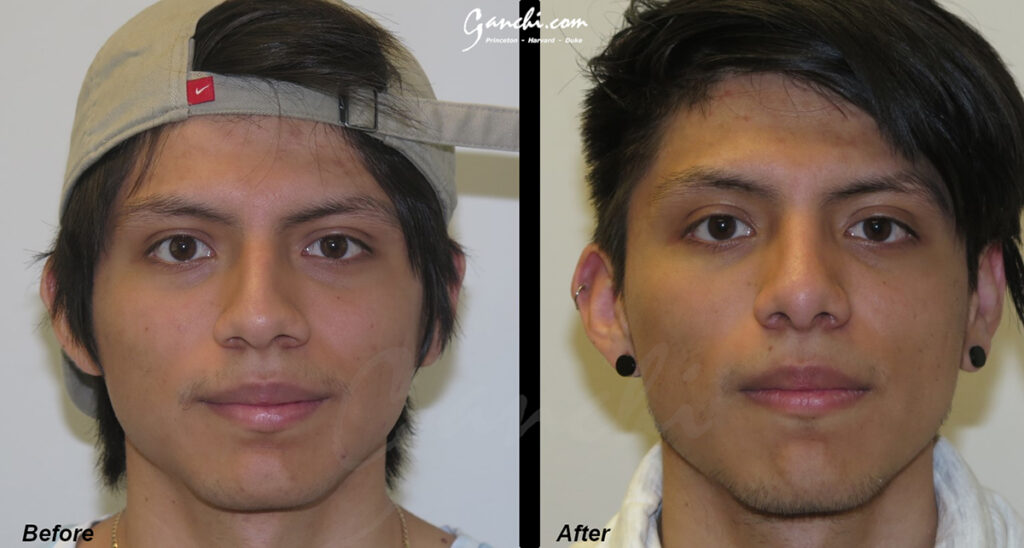 Rhinoplasty Before and After Photo by Ganchi Plastic Surgery in Northern New Jersey