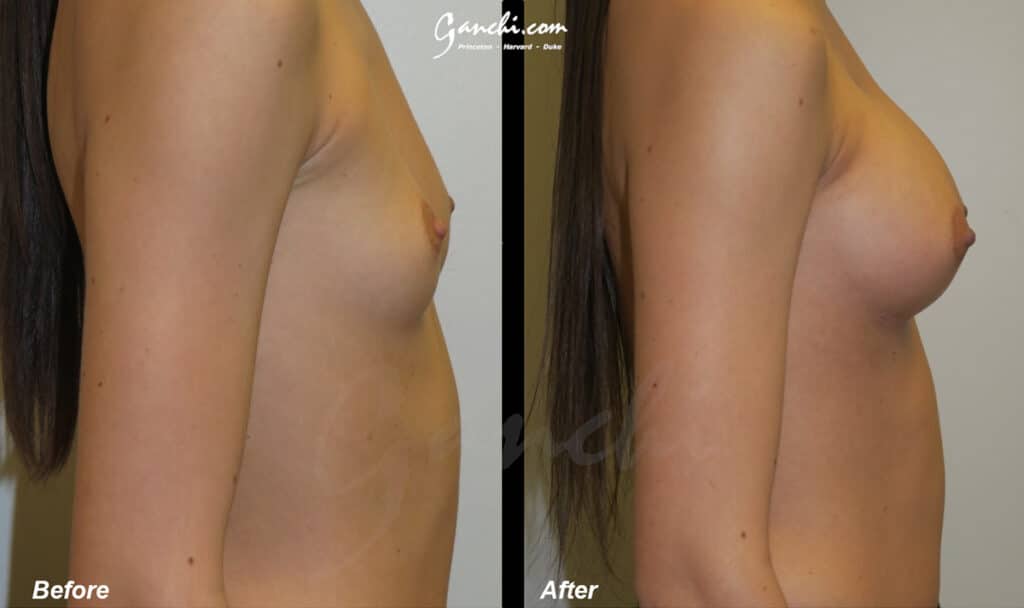 Breast Augmentation Before and After Photo by Ganchi Plastic Surgery in Northern New Jersey