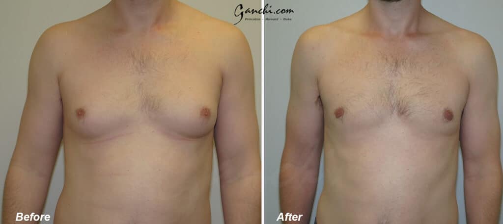 Gynecomastia Before and After Photo by Ganchi Plastic Surgery in Northern New Jersey
