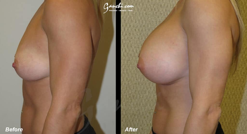 Breast Augmentation Before and After Photo by Ganchi Plastic Surgery in Northern New Jersey
