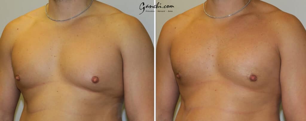 Gynecomastia Before and After Photo by Ganchi Plastic Surgery in Northern New Jersey