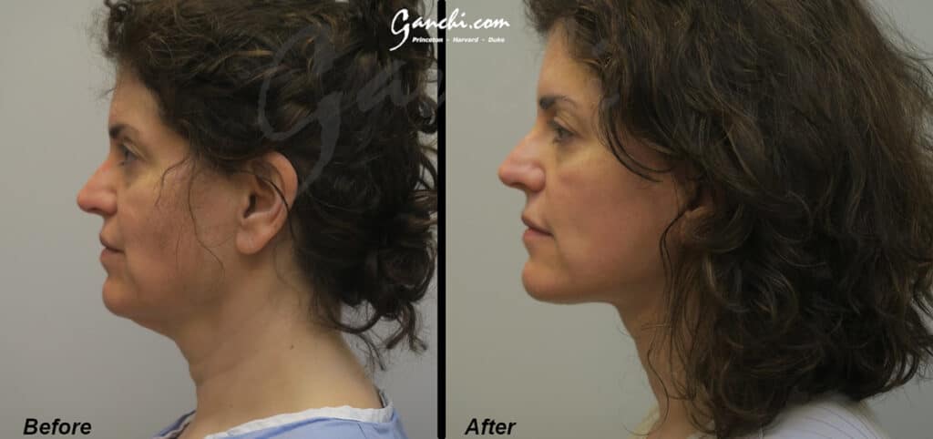 Face/Neck Lift Before and After Photo by Ganchi Plastic Surgery in Northern New Jersey