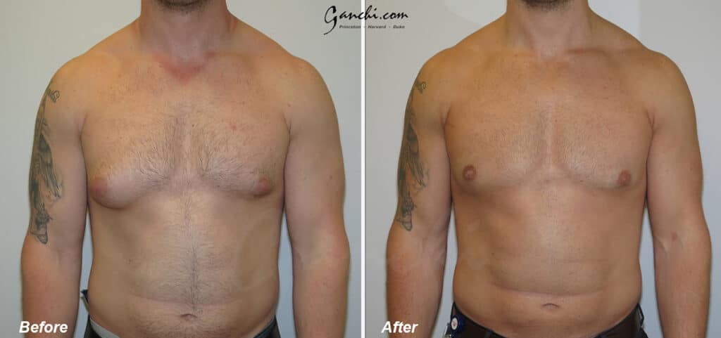 Gynecomastia Before and After Photo by Ganchi Plastic Surgery in Northern New Jersey
