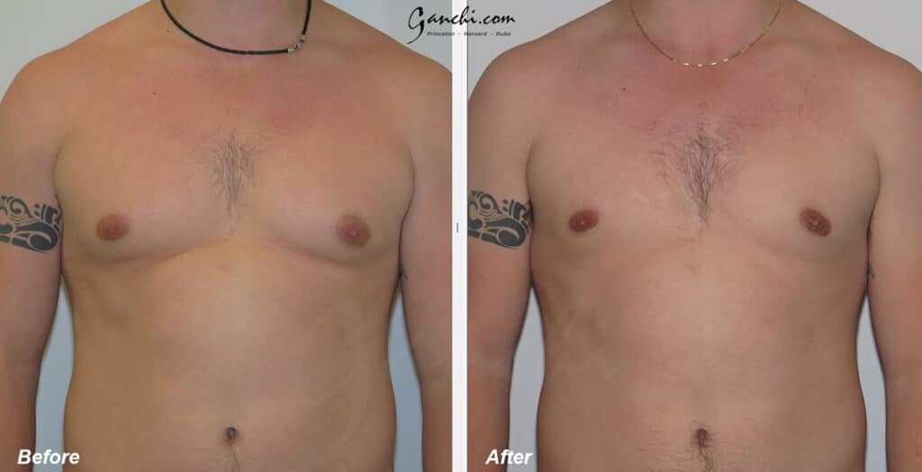 Gynecomastia Before and After Photo by Ganchi Plastic Surgery in Northern New Jersey