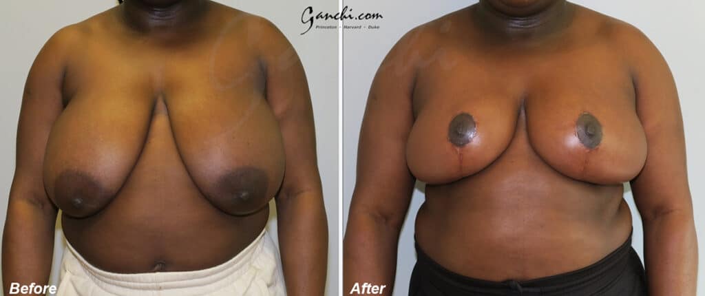 Breast Reduction Before and After Photo by Ganchi Plastic Surgery in Northern New Jersey