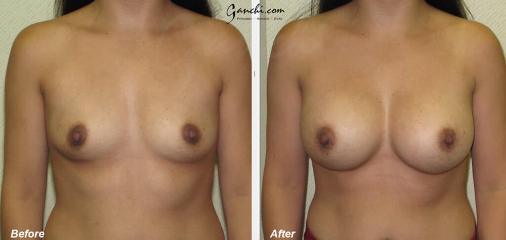 Breast Augmentation Before and After Photo by Ganchi Plastic Surgery in Northern New Jersey