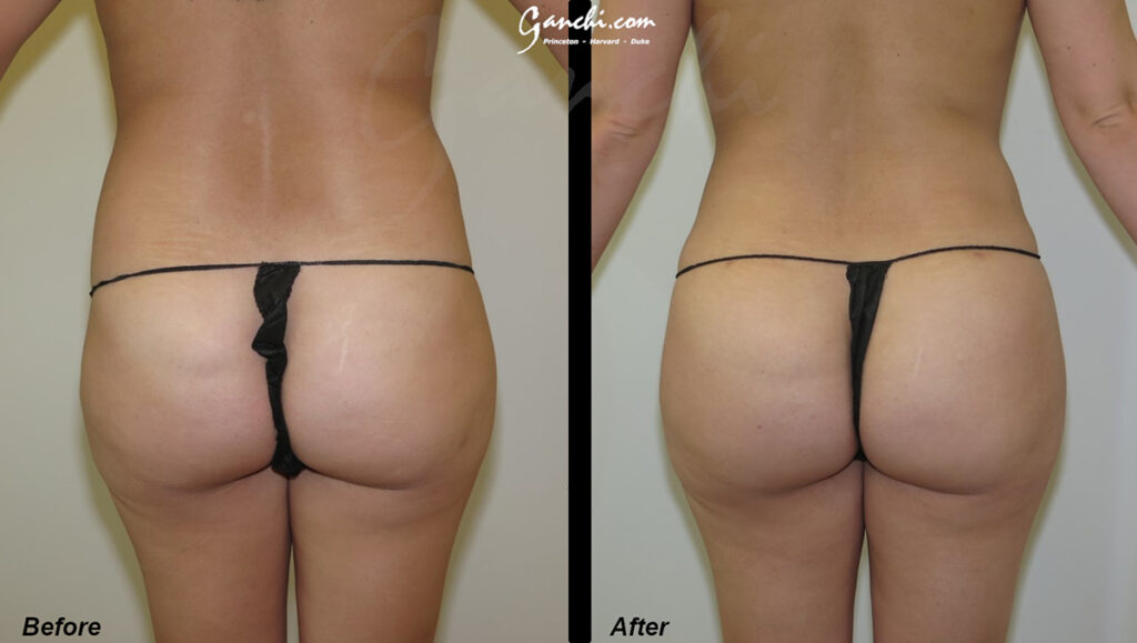 Buttock Augmentation Before and After Photo by Ganchi Plastic Surgery in Northern New Jersey