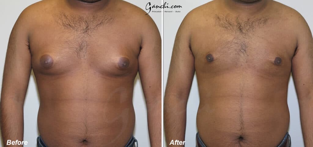 Gynecomastia Before and After Photo by Ganchi Plastic Surgery in Northern New Jersey