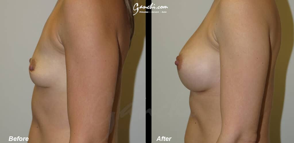 Breast Augmentation Before and After Photo by Ganchi Plastic Surgery in Northern New Jersey
