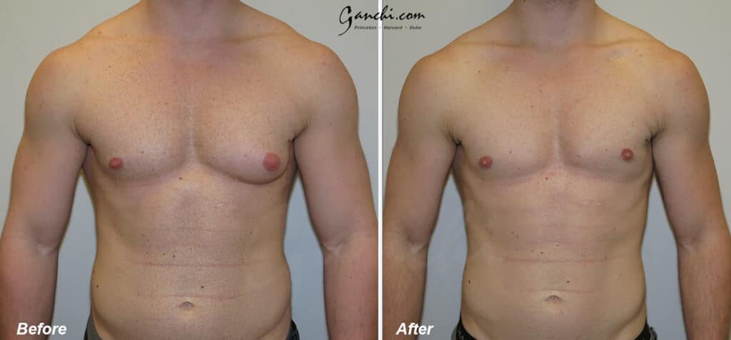 Gynecomastia Before and After Photo by Ganchi Plastic Surgery in Northern New Jersey