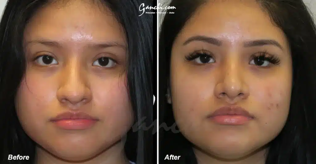 Rhinoplasty Before and After Photo by Ganchi Plastic Surgery in Northern New Jersey