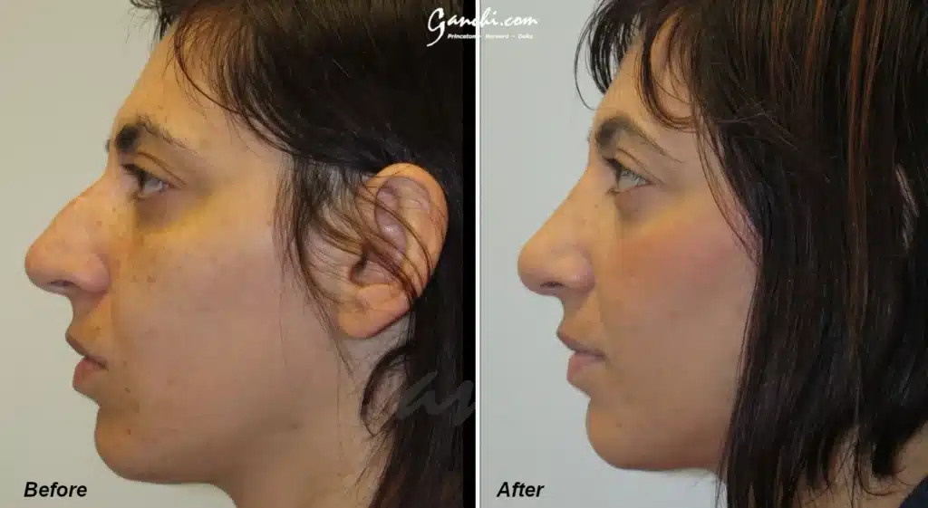 Rhinoplasty Before and After Photo by Ganchi Plastic Surgery in Northern New Jersey