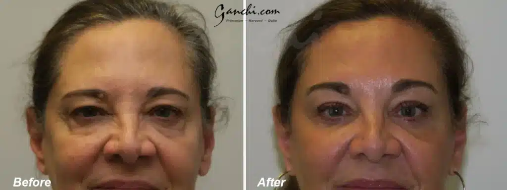 Eyelid Lift Before and After Photo by Ganchi Plastic Surgery in Northern New Jersey
