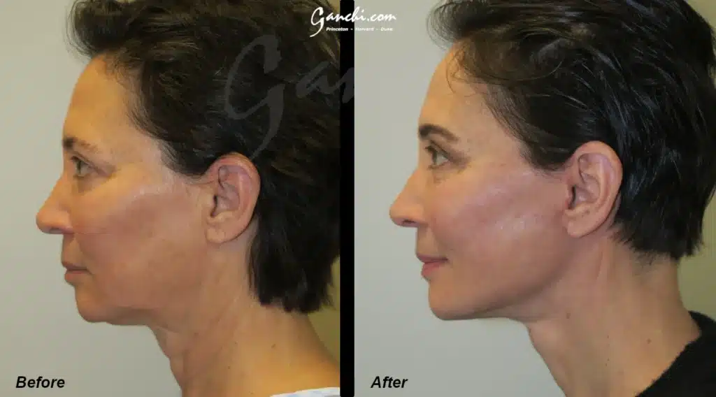 Face & Neck Lift Before and After Photo by Ganchi Plastic Surgery in Northern New Jersey