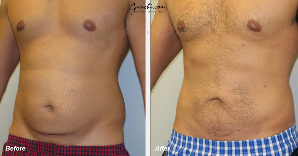 Liposuction Before and After Photo by Ganchi Plastic Surgery in Northern New Jersey