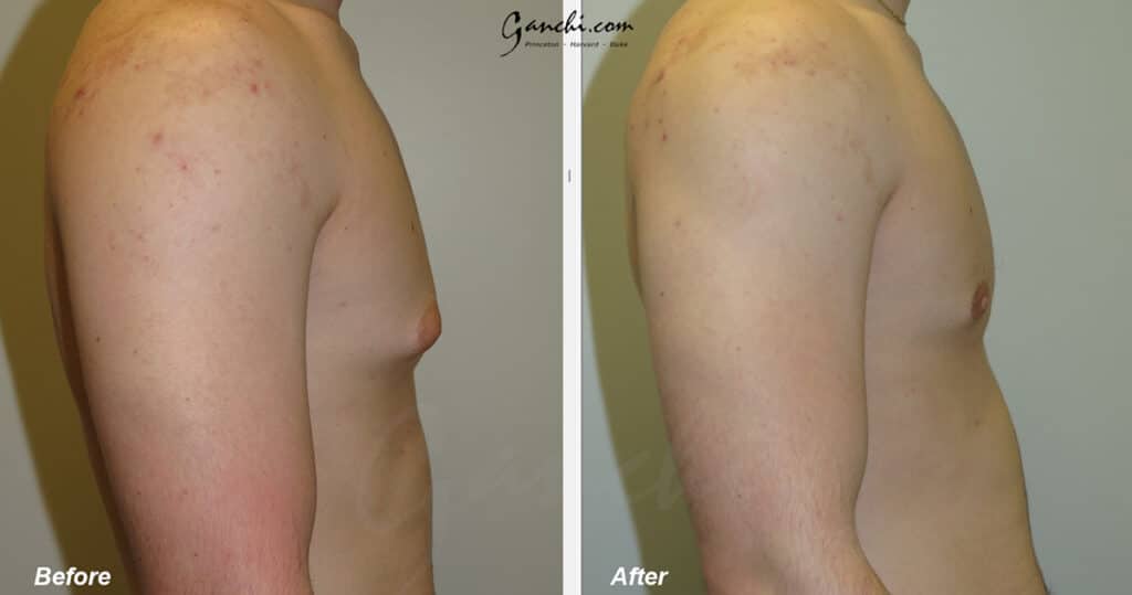Gynecomastia Before and After Photo by Ganchi Plastic Surgery in Northern New Jersey