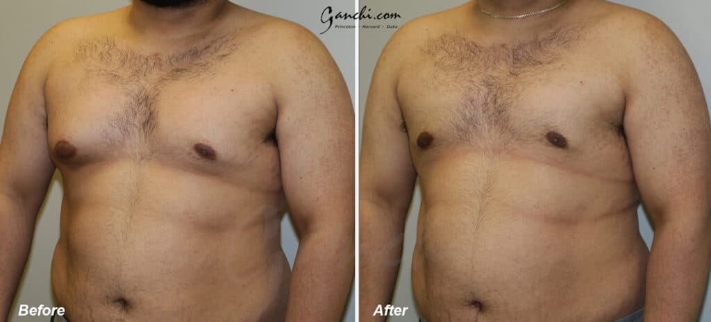 Gynecomastia Before and After Photo by Ganchi Plastic Surgery in Northern New Jersey