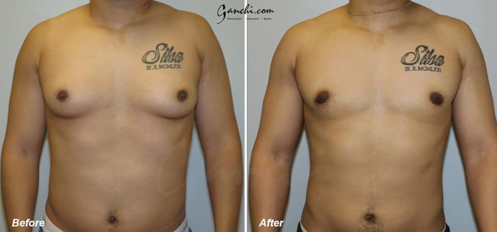 Gynecomastia Before and After Photo by Ganchi Plastic Surgery in Northern New Jersey
