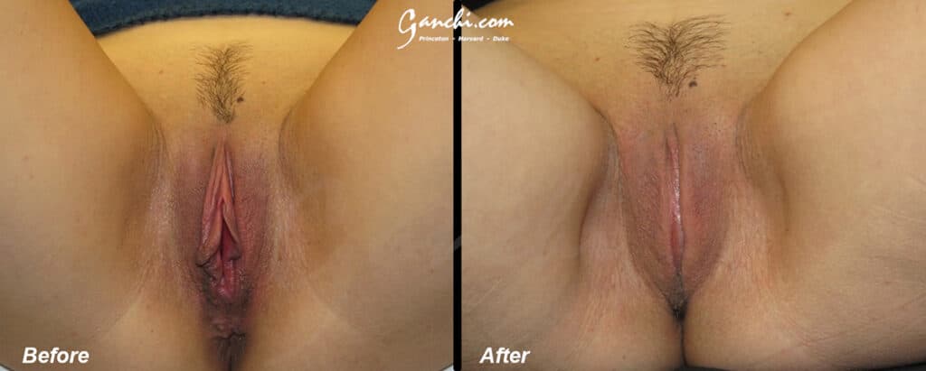Labiaplasty Before and After Photo by Ganchi Plastic Surgery in Northern New Jersey