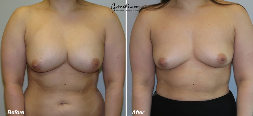 Breast Implant Revision Before and After Photo by Ganchi Plastic Surgery in Northern New Jersey