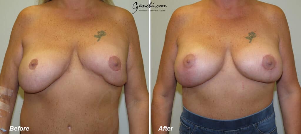 Breast Implant Revision Before and After Photo by Ganchi Plastic Surgery in Northern New Jersey