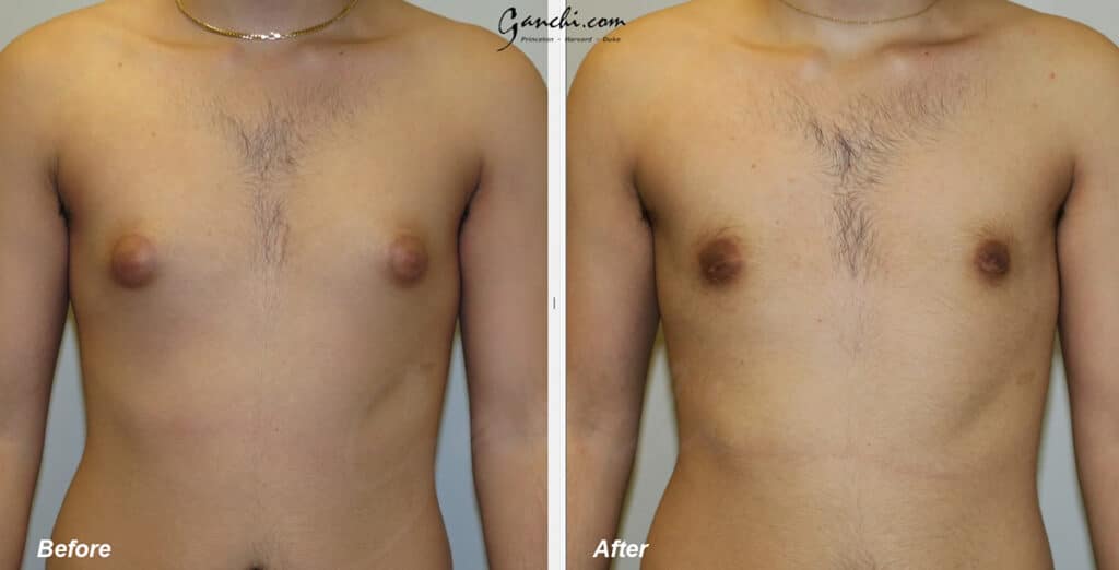 Gynecomastia Before and After Photo by Ganchi Plastic Surgery in Northern New Jersey