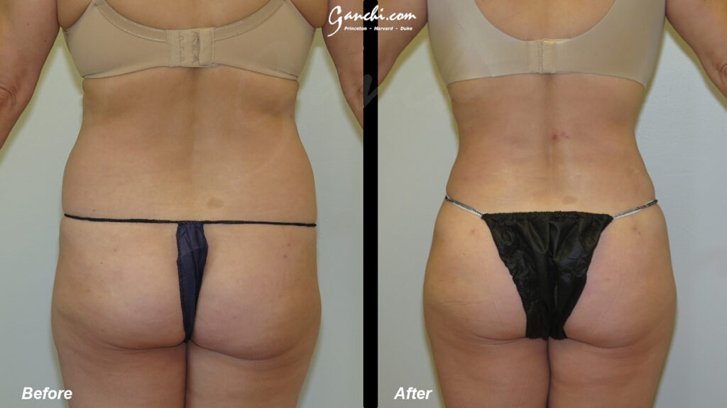 Liposuction Before and After Photo by Ganchi Plastic Surgery in Northern New Jersey