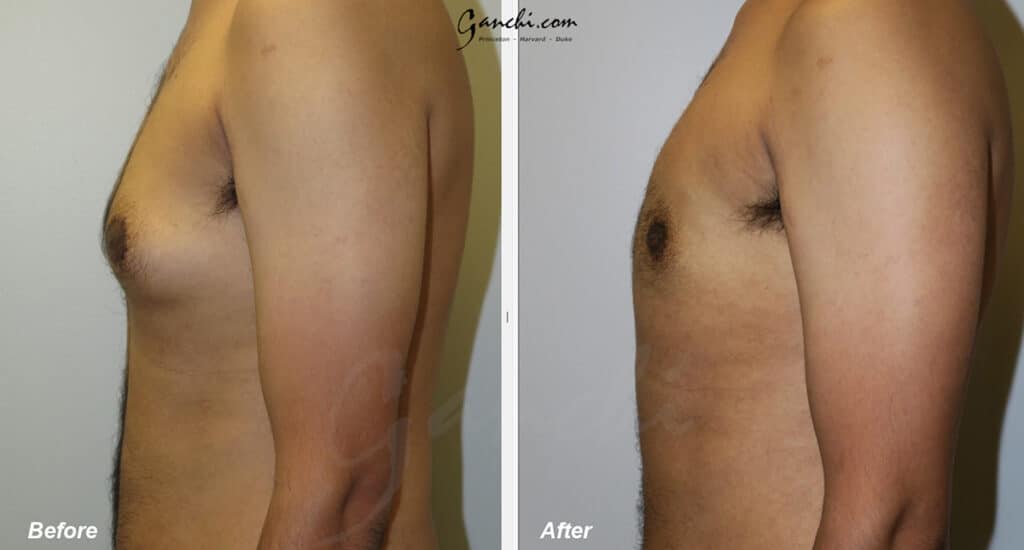 Gynecomastia Before and After Photo by Ganchi Plastic Surgery in Northern New Jersey