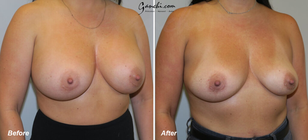Breast Implant Revision Before and After Photo by Ganchi Plastic Surgery in Northern New Jersey
