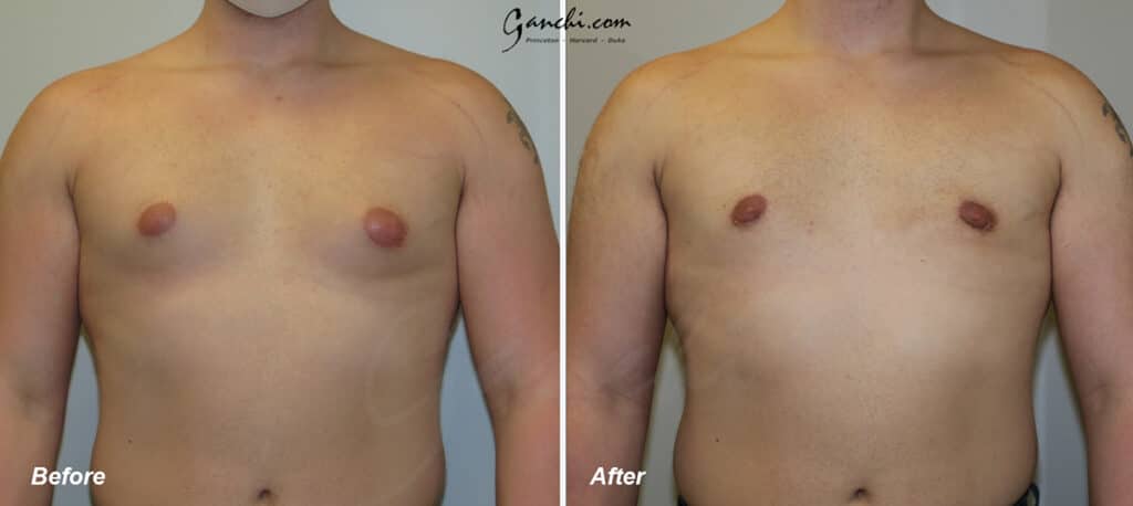 Gynecomastia Before and After Photo by Ganchi Plastic Surgery in Northern New Jersey