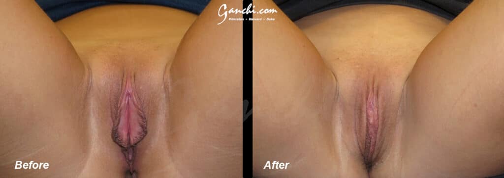 Labiaplasty Before and After Photo by Ganchi Plastic Surgery in Northern New Jersey