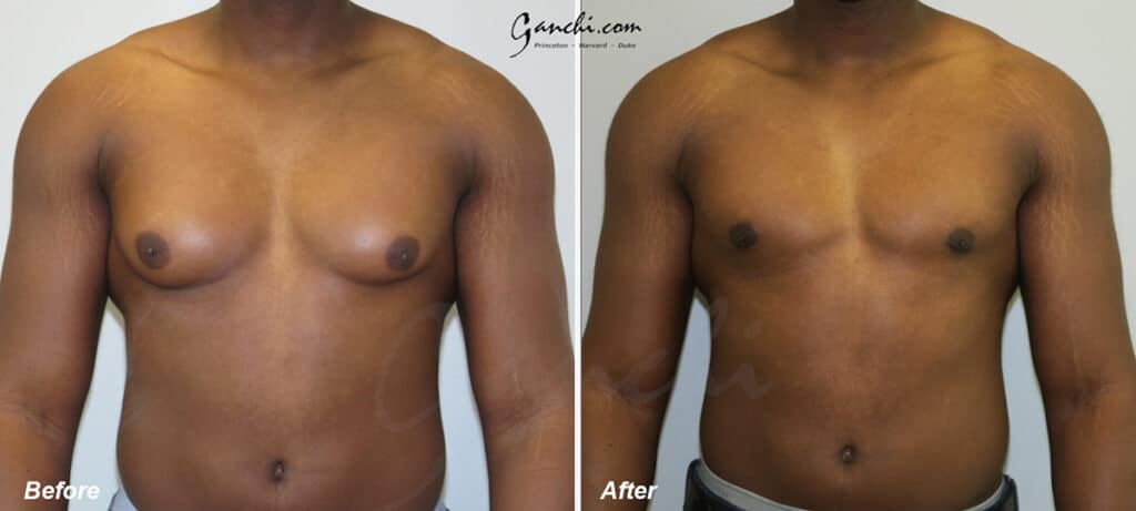 Gynecomastia Before and After Photo by Ganchi Plastic Surgery in Northern New Jersey