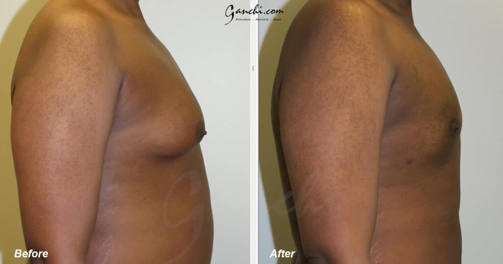 Gynecomastia Before and After Photo by Ganchi Plastic Surgery in Northern New Jersey