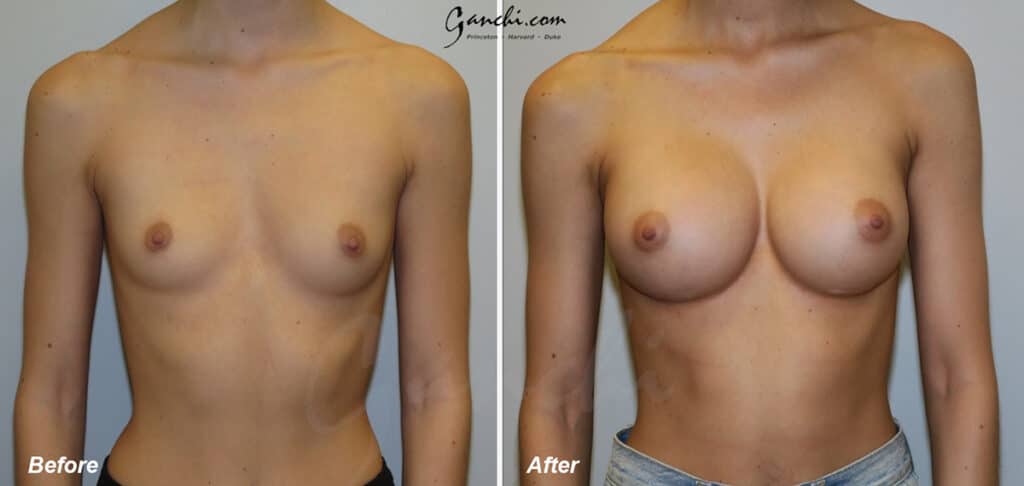 Breast Augmentation Before and After Photo by Ganchi Plastic Surgery in Northern New Jersey