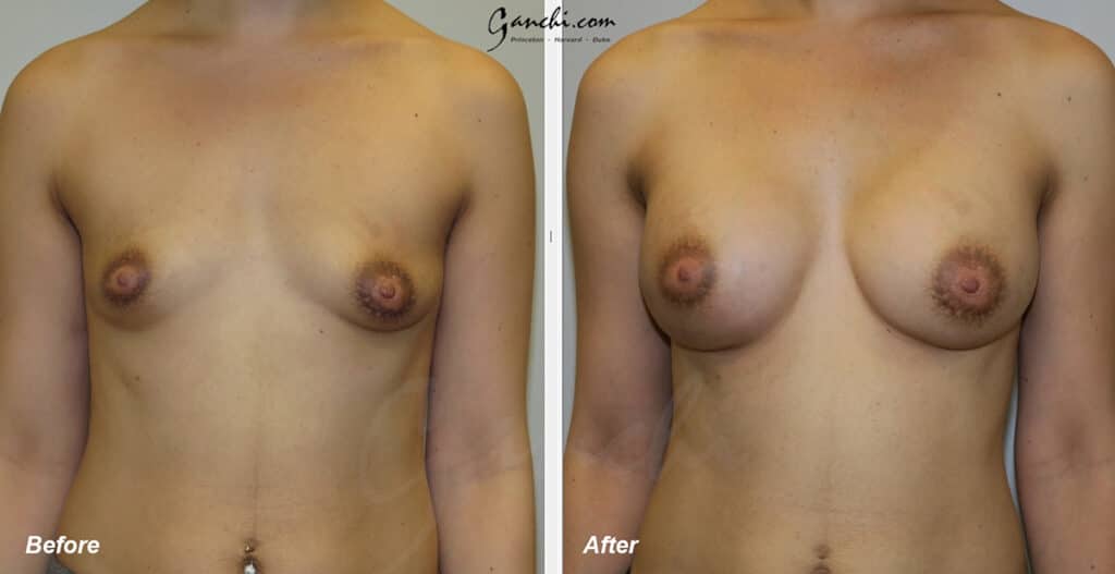 Breast Augmentation Before and After Photo by Ganchi Plastic Surgery in Northern New Jersey