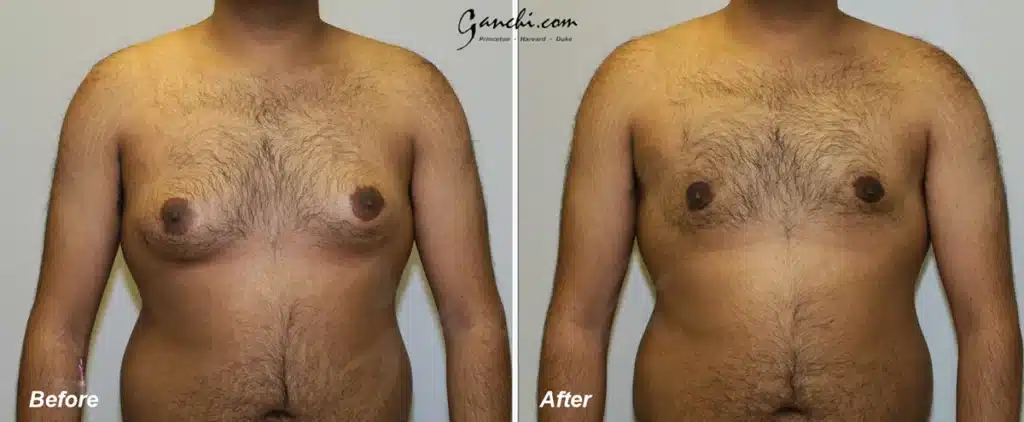Gynecomastia Before and After Photo by Ganchi Plastic Surgery in Northern New Jersey