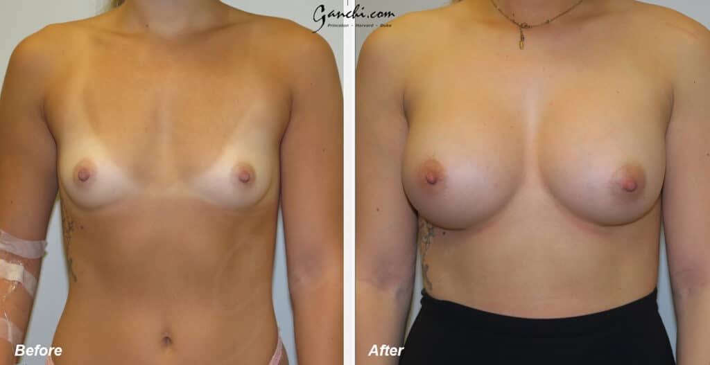 Breast Augmentation Before and After Photo by Ganchi Plastic Surgery in Northern New Jersey