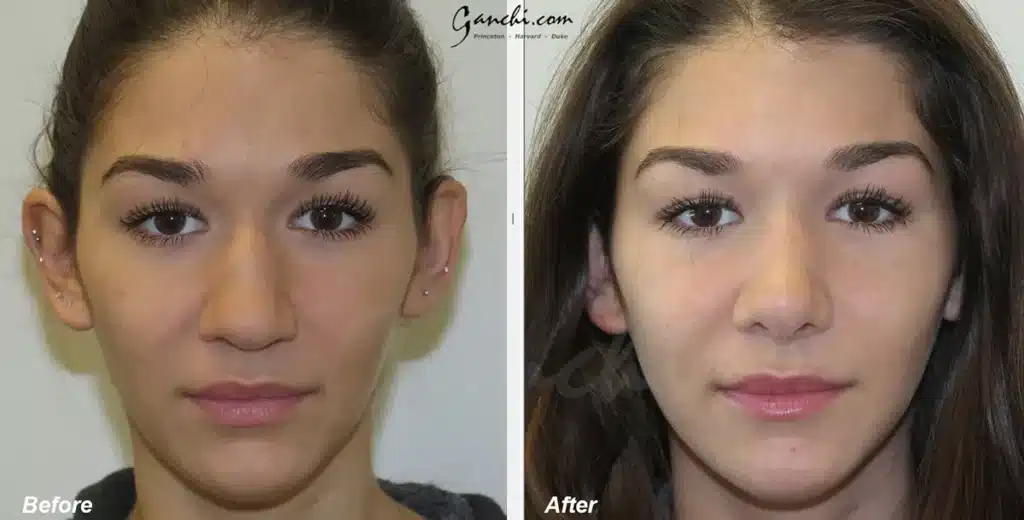 Rhinoplasty Before and After Photo by Ganchi Plastic Surgery in Northern New Jersey