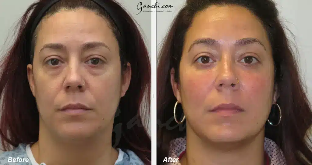 Lower Blepharoplasty Before and After Photo by Ganchi Plastic Surgery in Northern New Jersey