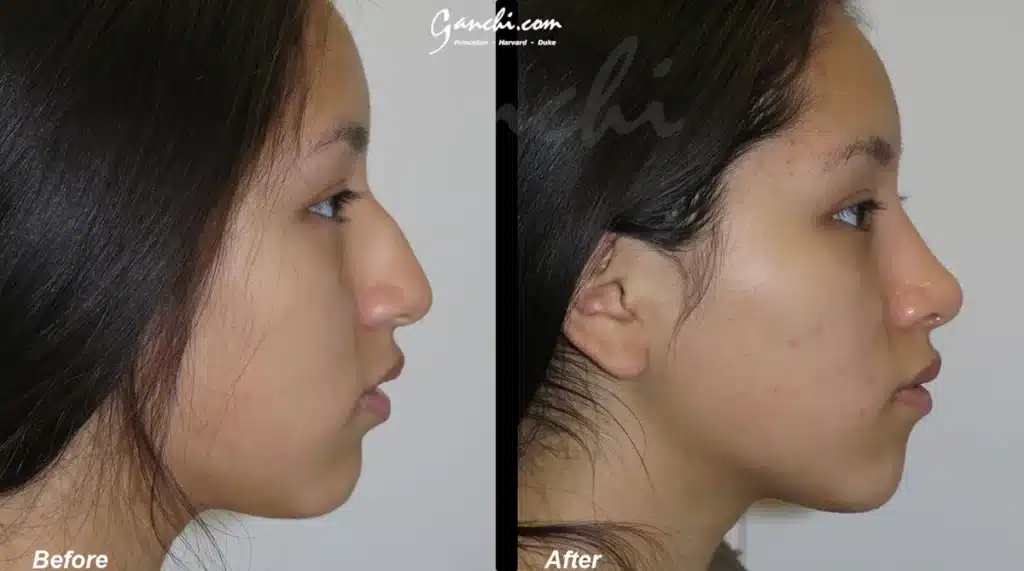 Rhinoplasty Before and After Photo by Ganchi Plastic Surgery in Northern New Jersey