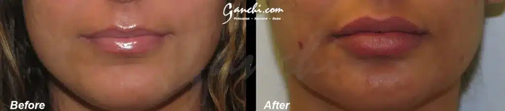 Lip Augmenation Before and After Photo by Ganchi Plastic Surgery in Northern New Jersey GM