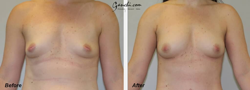 Breast Augmentation Before and After Photo by Ganchi Plastic Surgery in Northern New Jersey