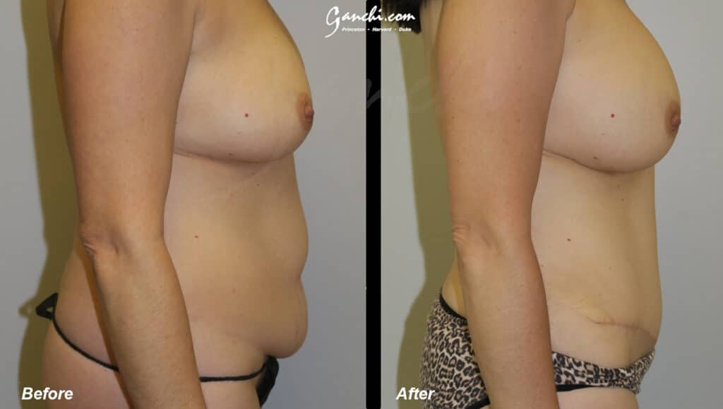Tummy Tuck Before and After Photo by Ganchi Plastic Surgery in Northern New Jersey